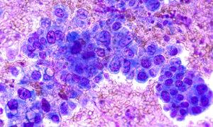 Sugar Stores in the Body May Fuel Common Lung Cancer Progression: Study